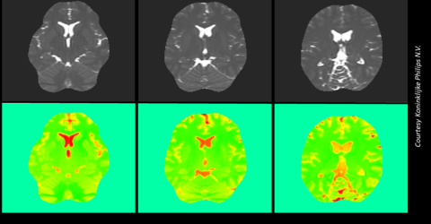 Six pictures showing a human brain scan. Three images in upper row showing black and white pictures of the brain and below these the corresponding EPT images in green with orange indicating tissue sub-types